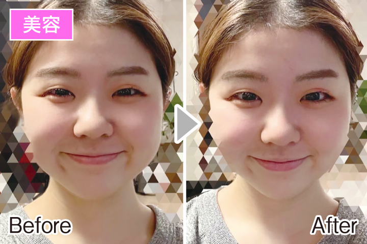 表情筋トレーニング